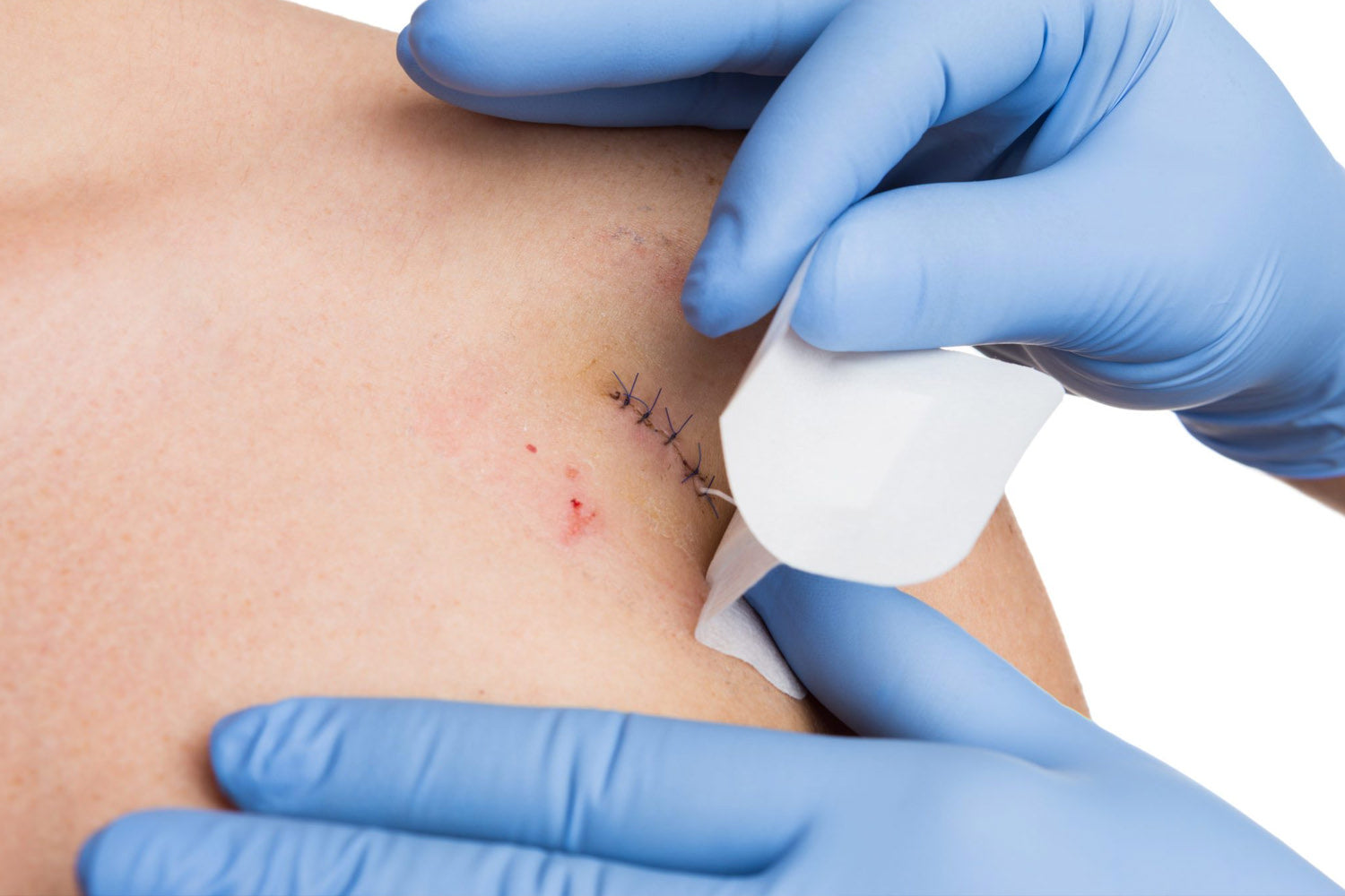 Post-Op Wound Care: Expectations and Solutions for Common Concerns